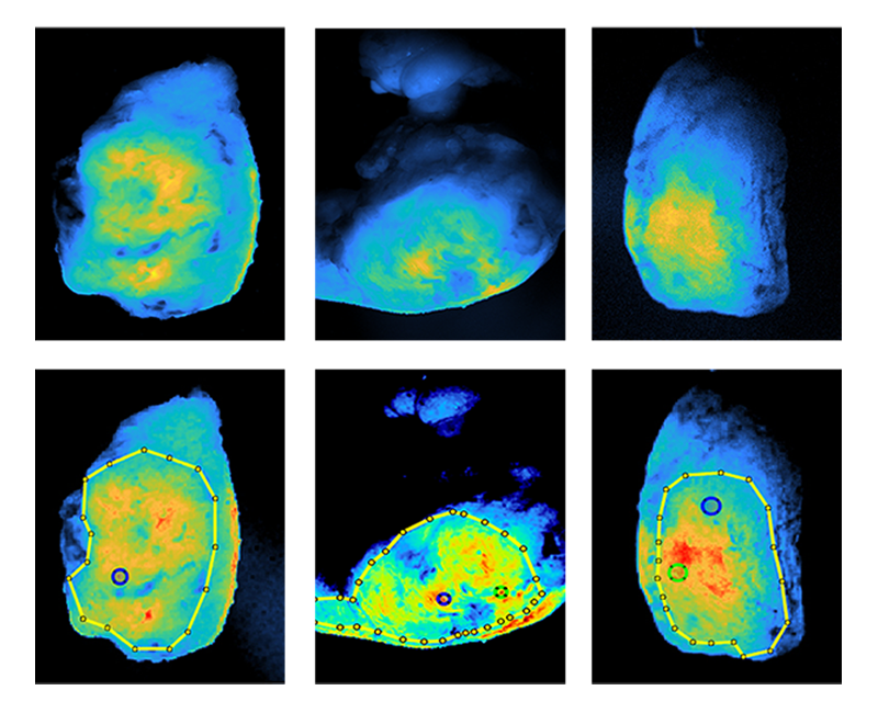 Brightly colored scans of tumors with drawn boundaries marking regions of interest